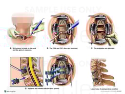Double Level Cervical Fusion