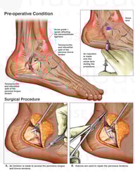 Right Ankle Injuries with Surgical Procedures
