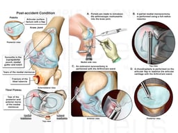 exh81953bLeft Knee Injuries with Arthroscopic Surgery