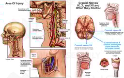 Carotid Endarterectomy with Subsequent Cranial Nerve Damage