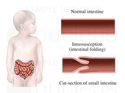 Intussusception
