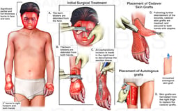 Burn Injuries with Surgical Debridement and Skin Grafting