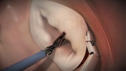 Robotic Mitral Valve Replacement