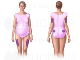 Injection Sites for Gestational Diabetes
