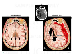 Traumatic Intracranial Hemorrhage