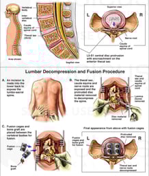 Lumbar Spine Injury - L5-S1 Disc Herniation with Posterior Spinal Fusion Surgery