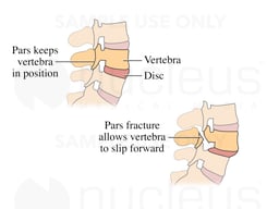Spine Injury - Pars Defect and Spondylolisthesis