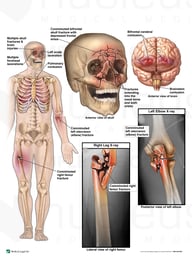 Multiple Traumatic Injuries