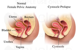 Urinary Bladder Prolapse with Cystocele