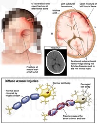 Scalp Laceration and Brain Injury with Damage to the Axons