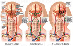 Interruption of the Cervical Vasculature with Infarction of the Left Frontal Lobe of the Brain