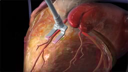 What are the Different Types of Coronary Artery Bypass Graft (CABG) Procedures?