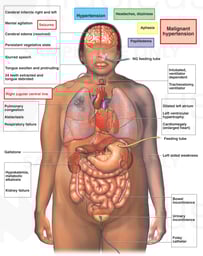 Medical Condition Including Hypertension and Papilledema