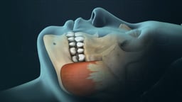 TMJ Disorders: Teeth Grinding