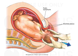 Shoulder Dystocia Birth Injury