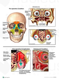 Endoscopic Sinus Surgery with Left Orbit Damage