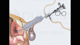Transurethral Resection of the Prostate (TURP)