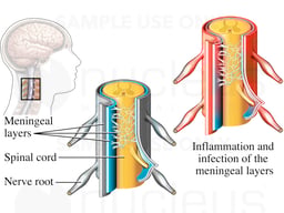 Spinal Meningitis