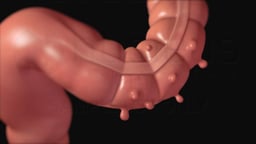 Diverticular Disease