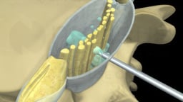 Spinal and Epidural Anesthesia