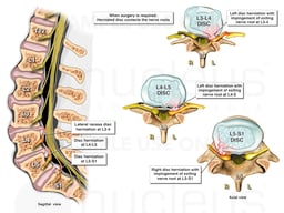 Herniated Lumbar Discs Contacting Nerve Roots