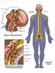 Prolonged Hyperextension with Permanent Spinal Cord Injury