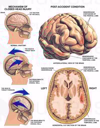Whiplash - Closed Head Injury with Resulting Brain Injury