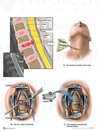 Cervical Disc Injury with Surgical Disc Replacement