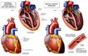 Normal Anatomy of the Heart vs. Heart with Blood Vessel Damage