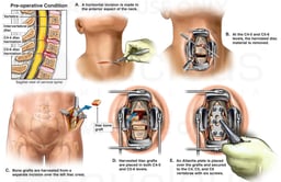 Whiplash Injury - Anterior Cervical Discectomy (Diskectomy) and Spinal Fusion Surgery