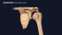 Damaged Shoulder Joint with Cartilage Erosion