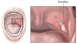 Tonsillitis