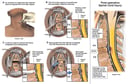 Anterior Cervical Discectomy and Fusion with Intra-operative Spinal Cord Injury