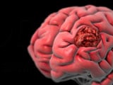 Brain Tumor