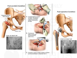 Right Femoral Neck Fracture with Total Hip Replacement