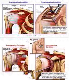 Impingement of the Supraspinatus Muscle with Open and Arthroscopic Surgical Repairs