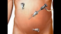 Laparoscopic Appendectomy Surgery