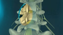 Laminectomy Surgical Procedure