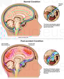 Post-traumatic Injury of the Brain and Pituitary Gland