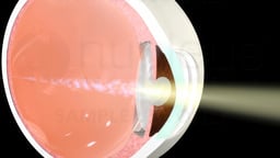 Cataract Surgery: Lens Extraction and Prosthetic Lens Insertion
