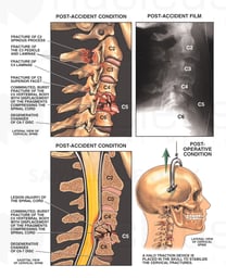 Post-accident Cervical Fractures