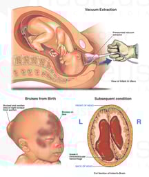Traumatic Vaginal Delivery with Vacuum Extraction and Head Injuries