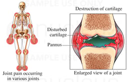 Rheumatoid Arthritis
