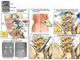 Left Lower Back Pain with Hardware Removal