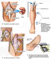 Initial Fixation of Right Lower Extremity Fractures