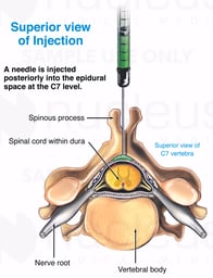 Nerve Block Injection in the Neck