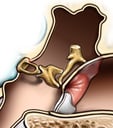 Ear Anatomy - Abnormal