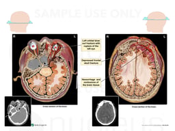 Post-accident CT Scans