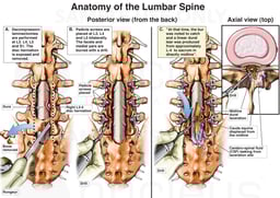 Lumbar Laminectomy