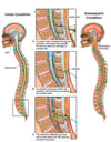 Progression of Meningitis Following Lumbar CSF Leak